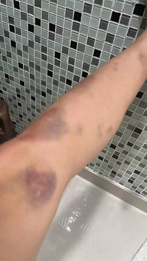 Fotos de Tati Zaqui e agressões cometidas por Thomaz Costa contra ela.