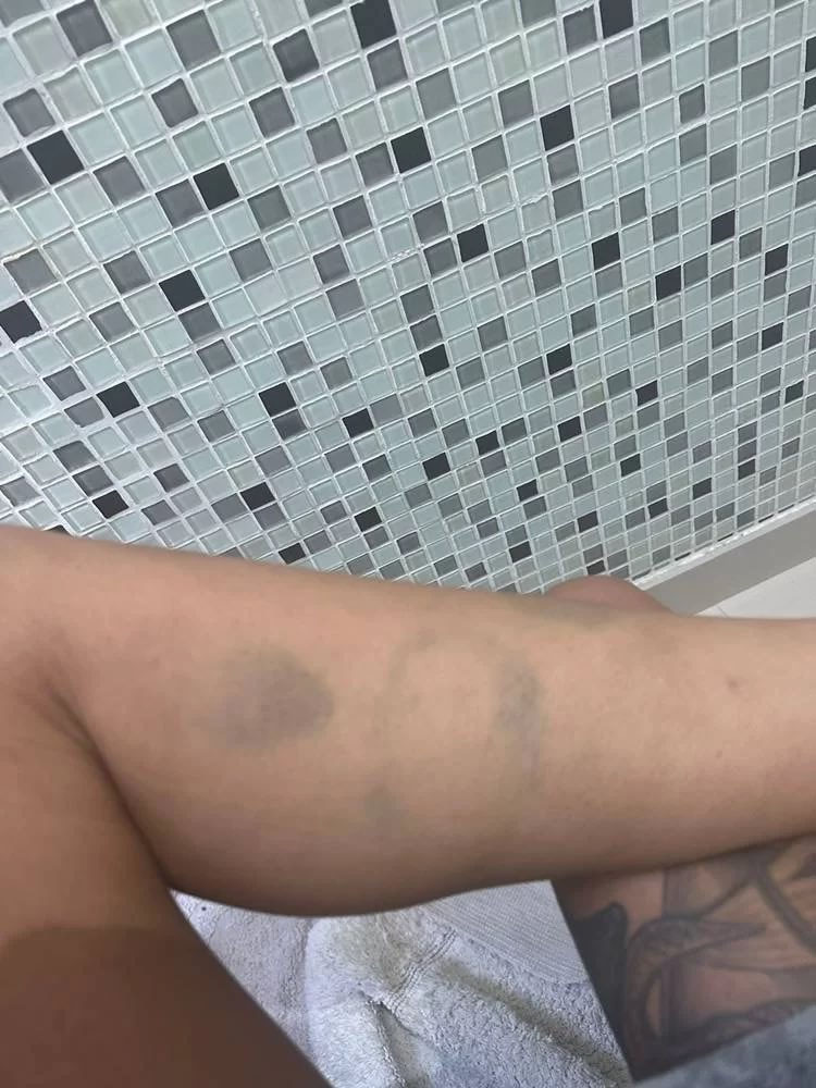 Fotos de Tati Zaqui e agressões cometidas por Thomaz Costa contra ela.